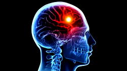 Exercise, low salt intake can reduce prevalence of stroke,others —EXPERTS