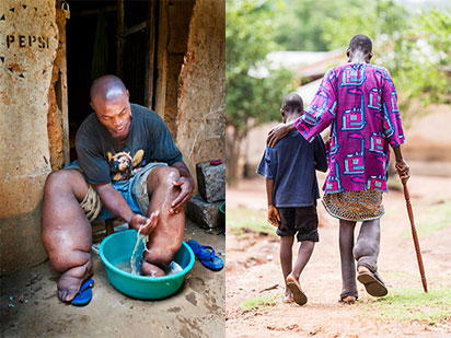 How Plateau, Nasarawa States eliminated Lymphatic filariasis