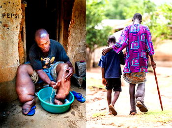 How Plateau, Nasarawa States eliminated Lymphatic filariasis