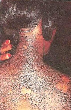 Bleaching: Three out of five women use toning cream