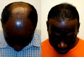 49 Year old Kaduna Civil Servant Exposes How He Re-grow His Hair Naturally, Cure Baldness and Severe Hair Loss within 14 days using a Natural Herbal Remedy