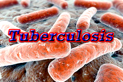 Tuberculosis infection: expert raises concern