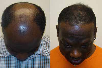 Abuja Man Exposes How He Re-grow His Hair Naturally, Cure Baldness and Severe Hair Loss within 14 days using a Natural Herbal Remedy