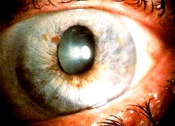 Silent blindness epidemic from glaucoma looms as cases surge