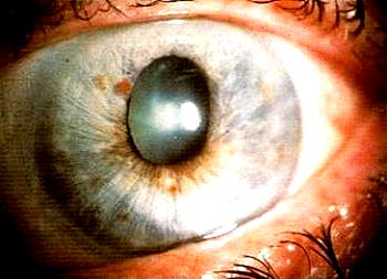 Glaucoma: 12–14m Nigerians at risk of vision loss — FG