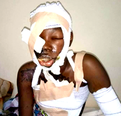 Photos: UNIMAID final year student bathed with acid