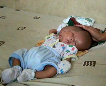 Baby in Indonesia born with 2 faces, 2 brains in one head