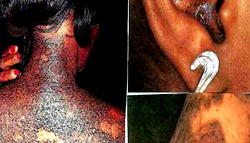 Alarm over rise in skin bleaching among Nigerians