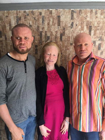 OAM Foundation empowers 28-year-old albino with skills
