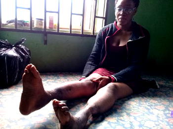 Chinonso, road accident victim seeks N7m to walk again