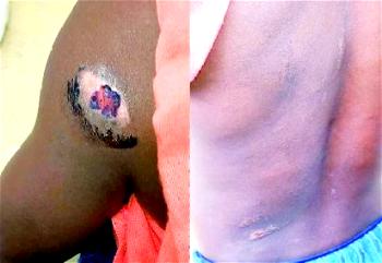 I burnt the shoulder of my house-help, 8, left her with 8 stitches — Nursing mother