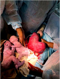 Woman with heart-shaped womb gives birth to twins