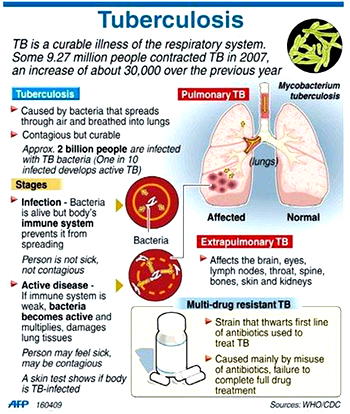 FG, USAID sign agreement to accelerate TB response