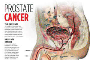 Prostate cancer treatment, a burden in Nigeria, says NGO
