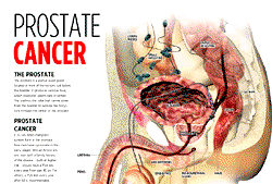 No diet, sex can prevent prostate cancer — Expert