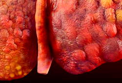 TREATMENT FOR HEPATITIS B : This Remedy Would Help Cure Your Hepatitis B Permanently In Just 8 Weeks.