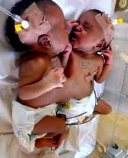 Abuja co-joined twins: Jobless, homeless, we almost abandoned our children – Parents