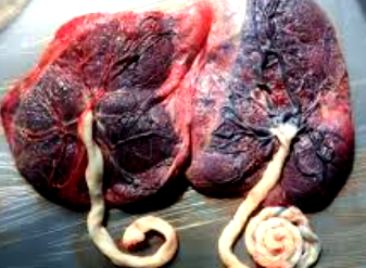 Muslim cleric, nurse nabbed over missing placenta