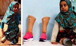Syrian girl born without legs walks on new prosthetics