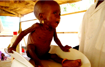 Insurgency worsens child malnutrition situation in North East –  expert