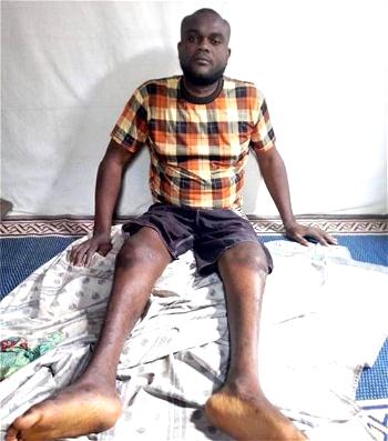 “Please help, don’t let me die,”cries 30-yr old man, crippled by hit-and-run driver