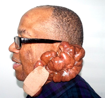 Keloids not harmful, says medical practitioner