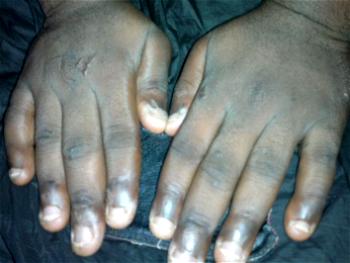 Stop nail biting, it makes you vulnerable to diseases, expert warns