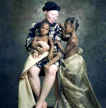 ‘White Ebony’ exhibition changing the narrative on albinos