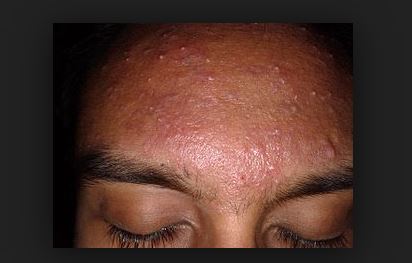 Acne
