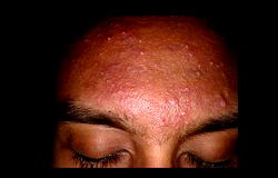 Tips for preventing acne