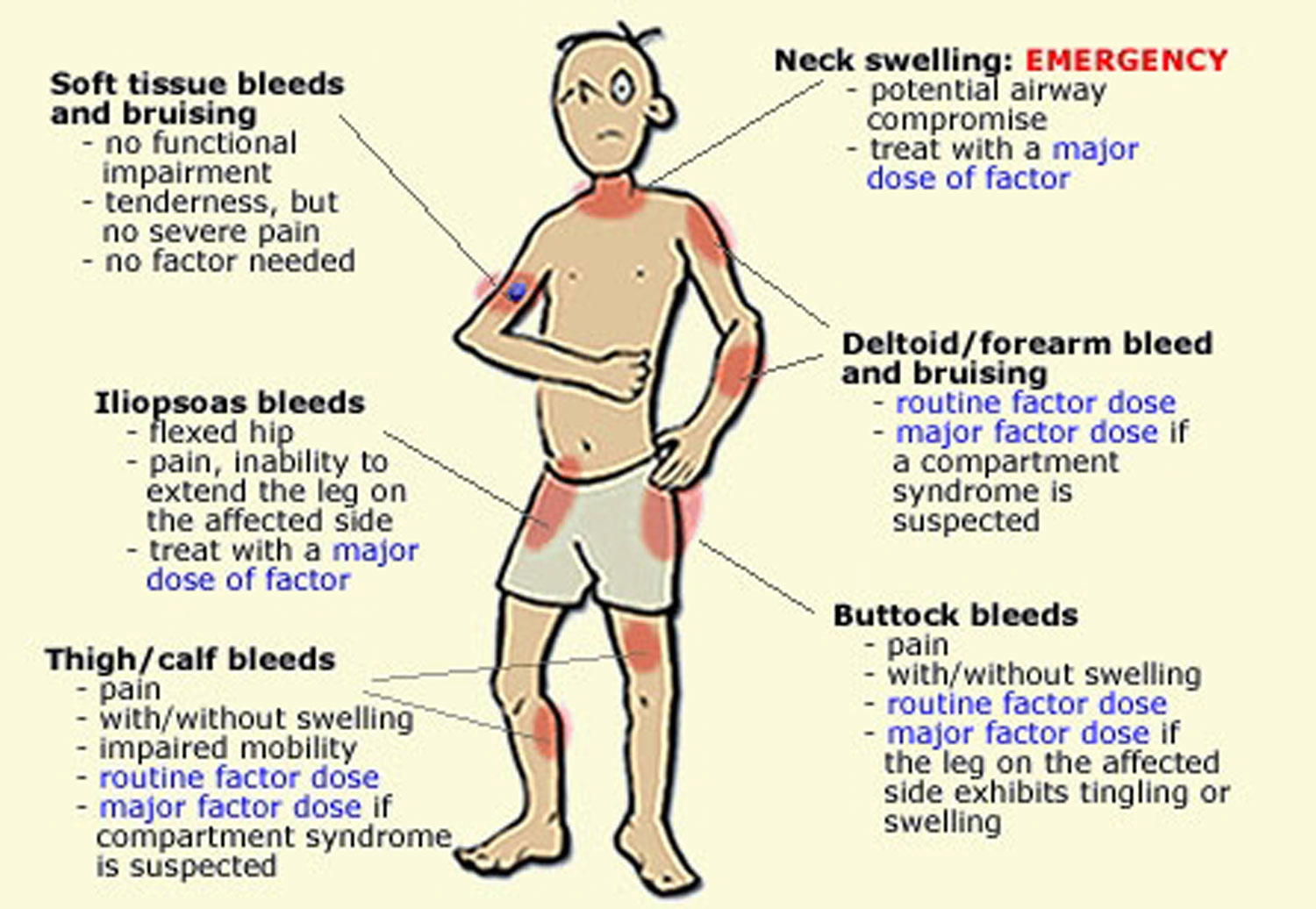Haemophilia: Keep away from ginger, dietitian advises