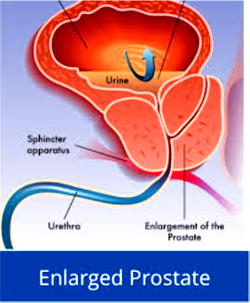 Prostate enlargement remedy