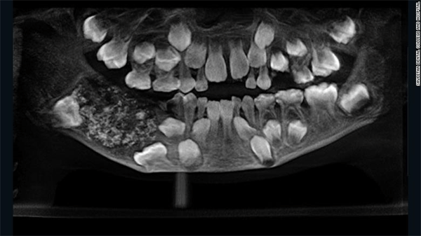 Forensic Odontology: How can your teeth help with investigation?