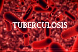 Bauchi detects 7,806 cases of tuberculosis