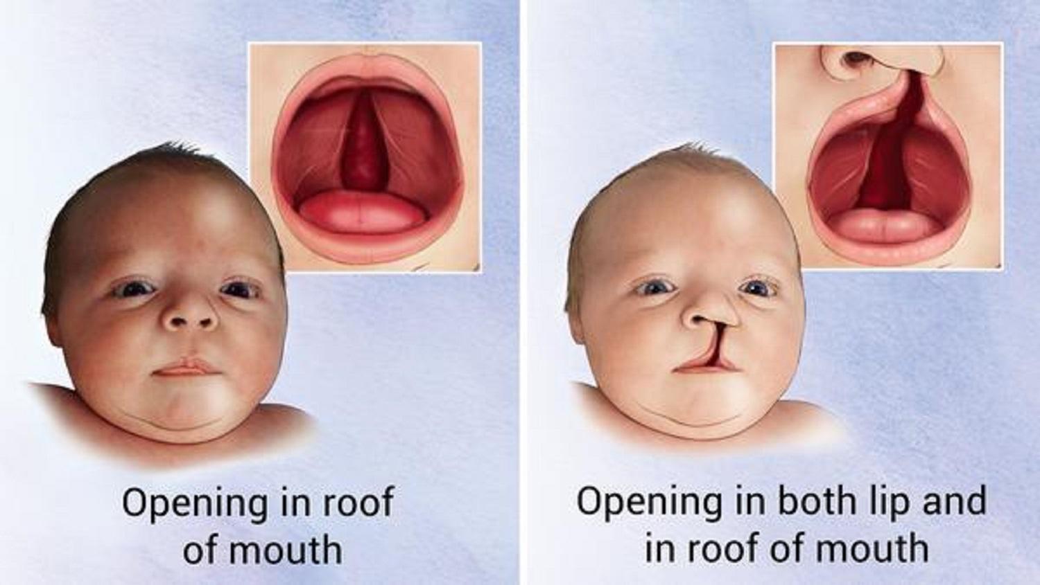 Cleft Lip And Palate Before And After Operation Smile