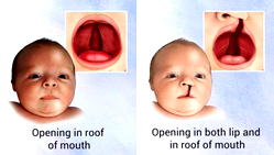 We have done over 28,000 successful cleft surgery in Nigeria ― SmileTrain