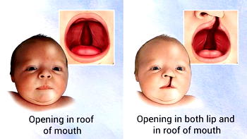 WACS trains 6 cleft care surgeons yearly