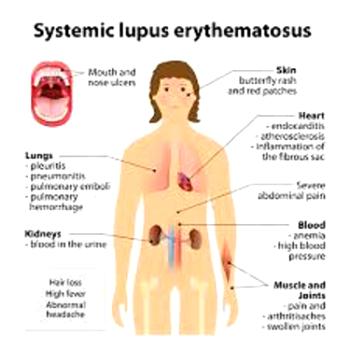 What you should know about Lupus