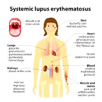 What you should know about Lupus