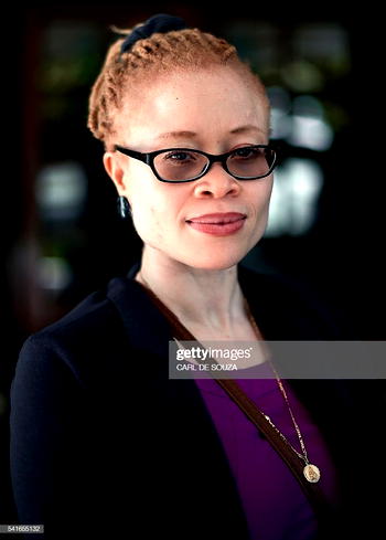 UN expert urges South Africa to end discrimination against people with albinism