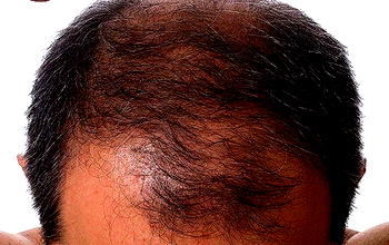 No one should suffer hair loss — VINCI