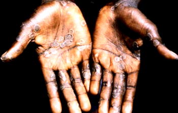 Abia confirms 3 cases of Monkey-pox