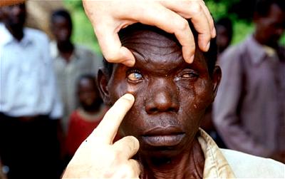 Over 1m blind adults live in Nigeria — Nzelu