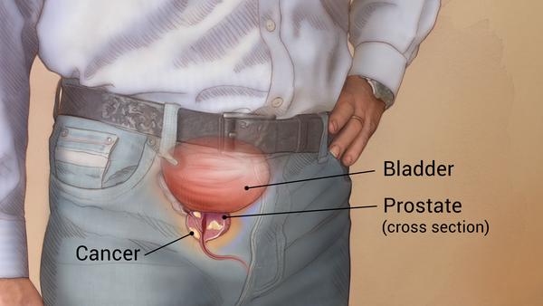 Be sexually active to prevent prostate cancer experts advise men