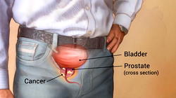 We have fears our libido will be lost — Prostate cancer survivors