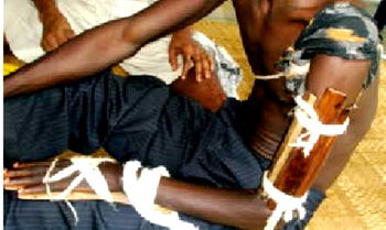 Quit patronising quack bone setters, expert warns Nigerians