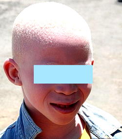 2023: Albino foundation demands inclusive political campaign