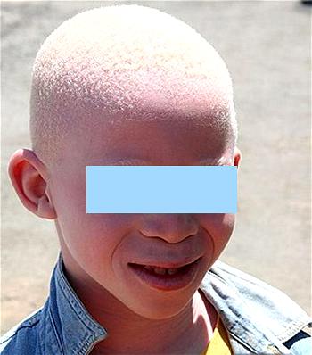 No scientific backing for albinos not to eat salt, dermatologist claims