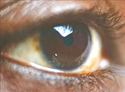 Igbos at higher risk of glaucoma blindness ― Govt Survey