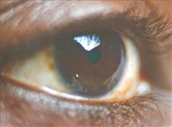 Igbos at higher risk of glaucoma blindness ― Govt Survey
